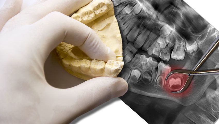 Usunięcie korzenia zęba -chirurgia stomatologiczna