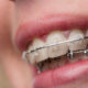 Ligatury ortodontyczne - ortodonta Toruń