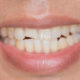 Pęknięty lub złamany ząb - jakie leczenie u dentysty pomoże?